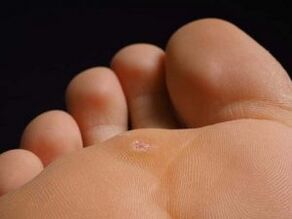 Causes of plantar warts
