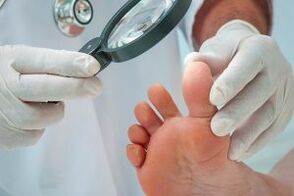 Treatment of plantar warts