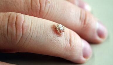 Methods to treat warts with Celandine