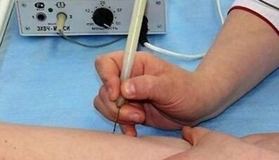 How to get rid of the papillomas in the body