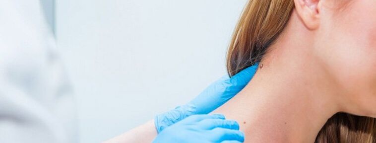 Papilloma in the neck