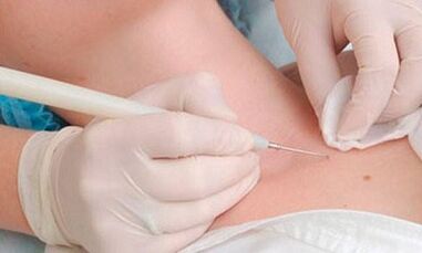 Papilloma removal methods in the neck