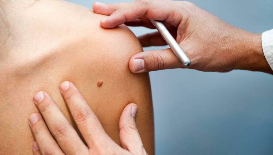 Dermatologist examining a patient with papilloma