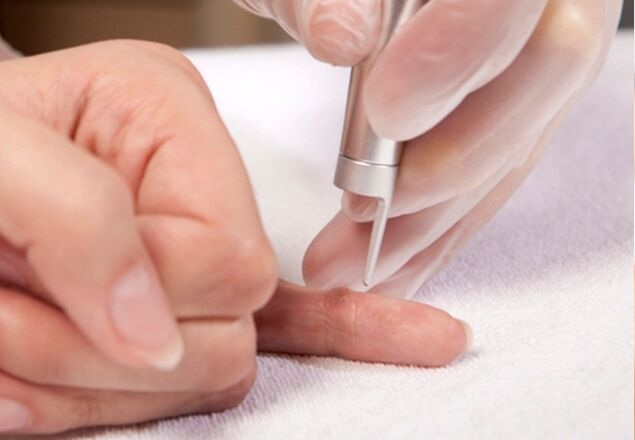 finger warts removal