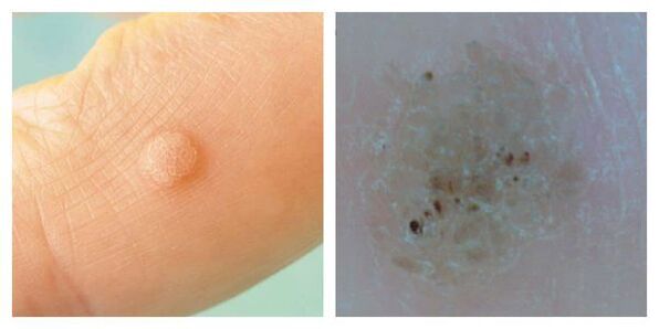 Common wart during examination and dermatoscopy