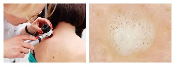 Dermatoscopy of wart