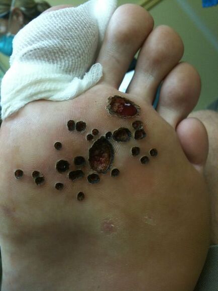 Skin after removal of the wart laser in the leg