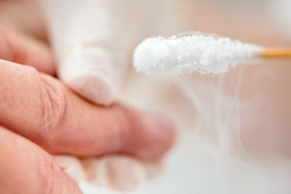 Treatment of wart with liquid nitrogen