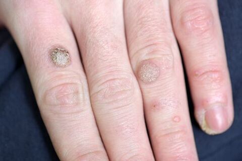 Warts on the arm