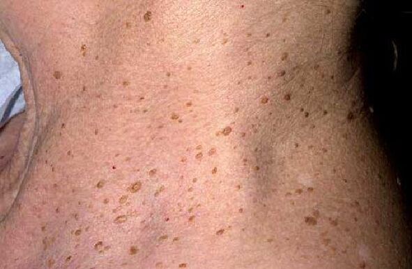 Senis Warts