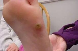 Warts in the hands